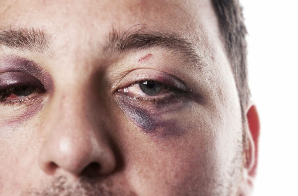 A close-up face of a man with  black eye on both eyes.