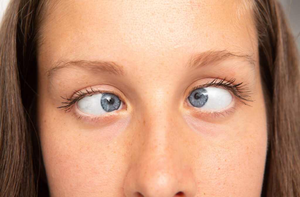 Close-up of a girl with blue eyes who has strabismus or crossed eyes.
