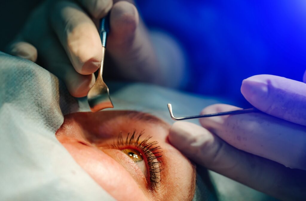 A close up of an eye about to be operated on to remove their cataracts.