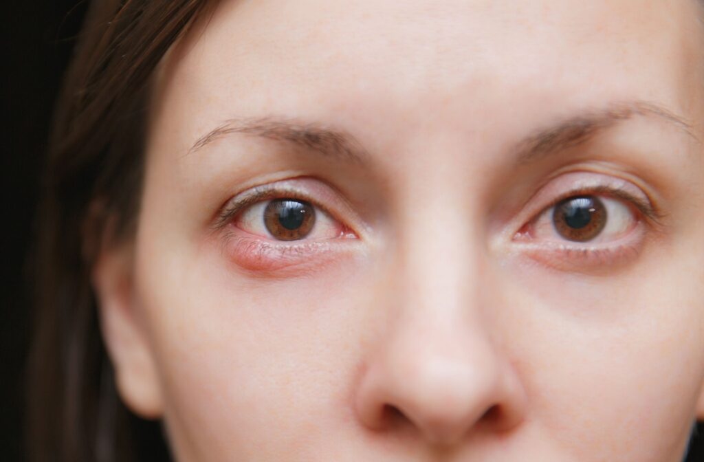 Close up of a red bump from a stye on a woman's eye