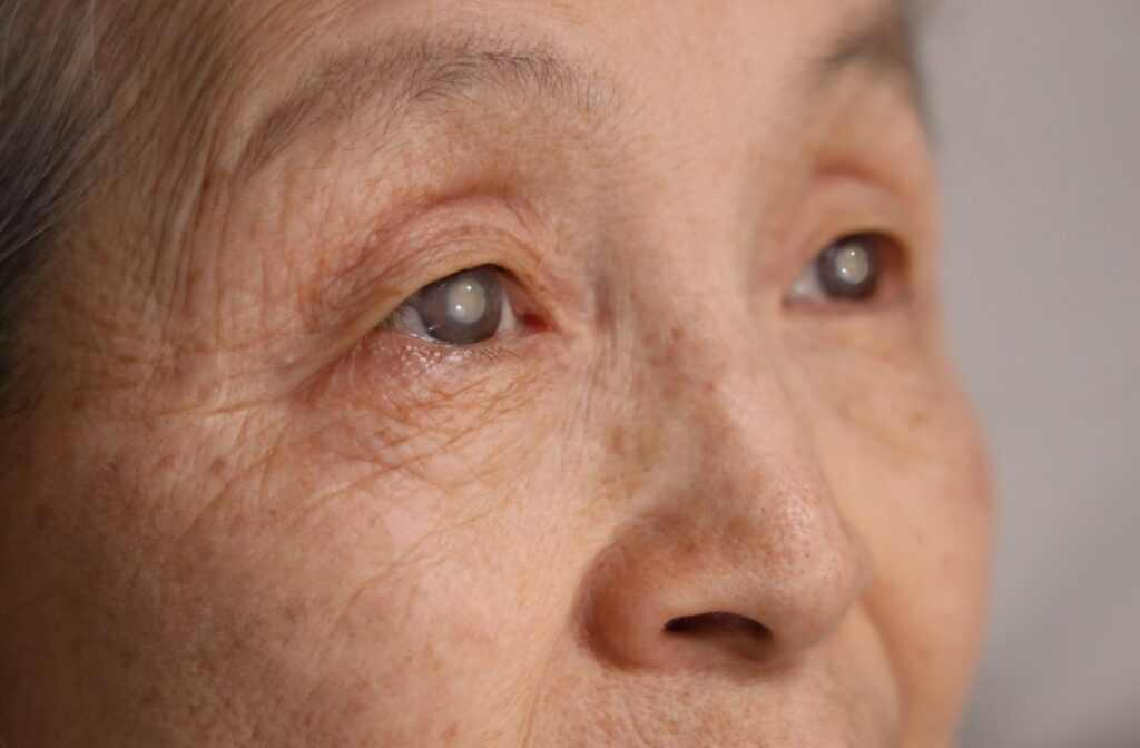 A close-up of a person's eyes, which shows signs of cataract because of their cloudy lens.