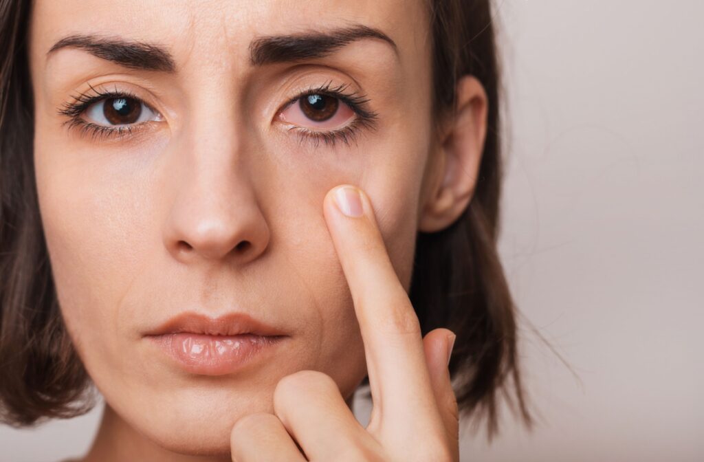 A person touches the skin under their eye, showing visible redness or irritation.