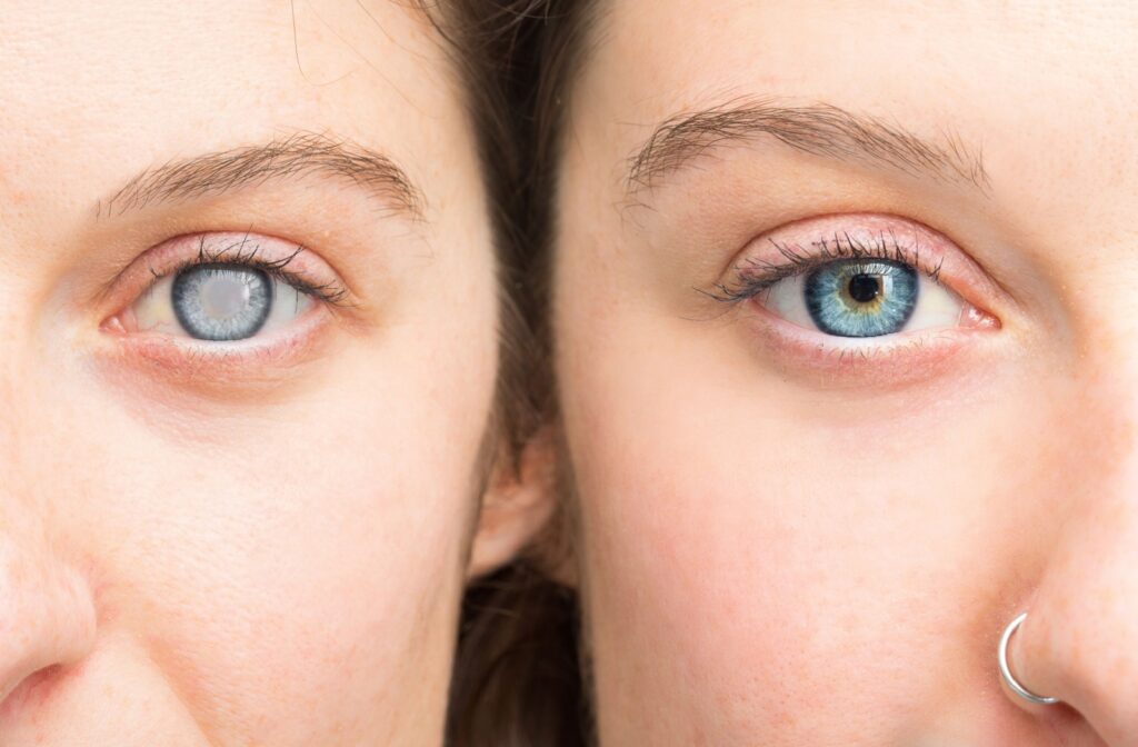 A side by side comparison of a normal eye and an eye with a cataract.