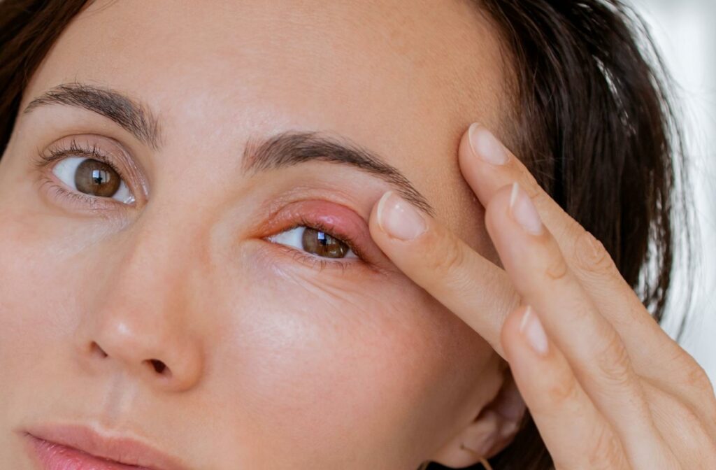 A close up of a person with a stye.
