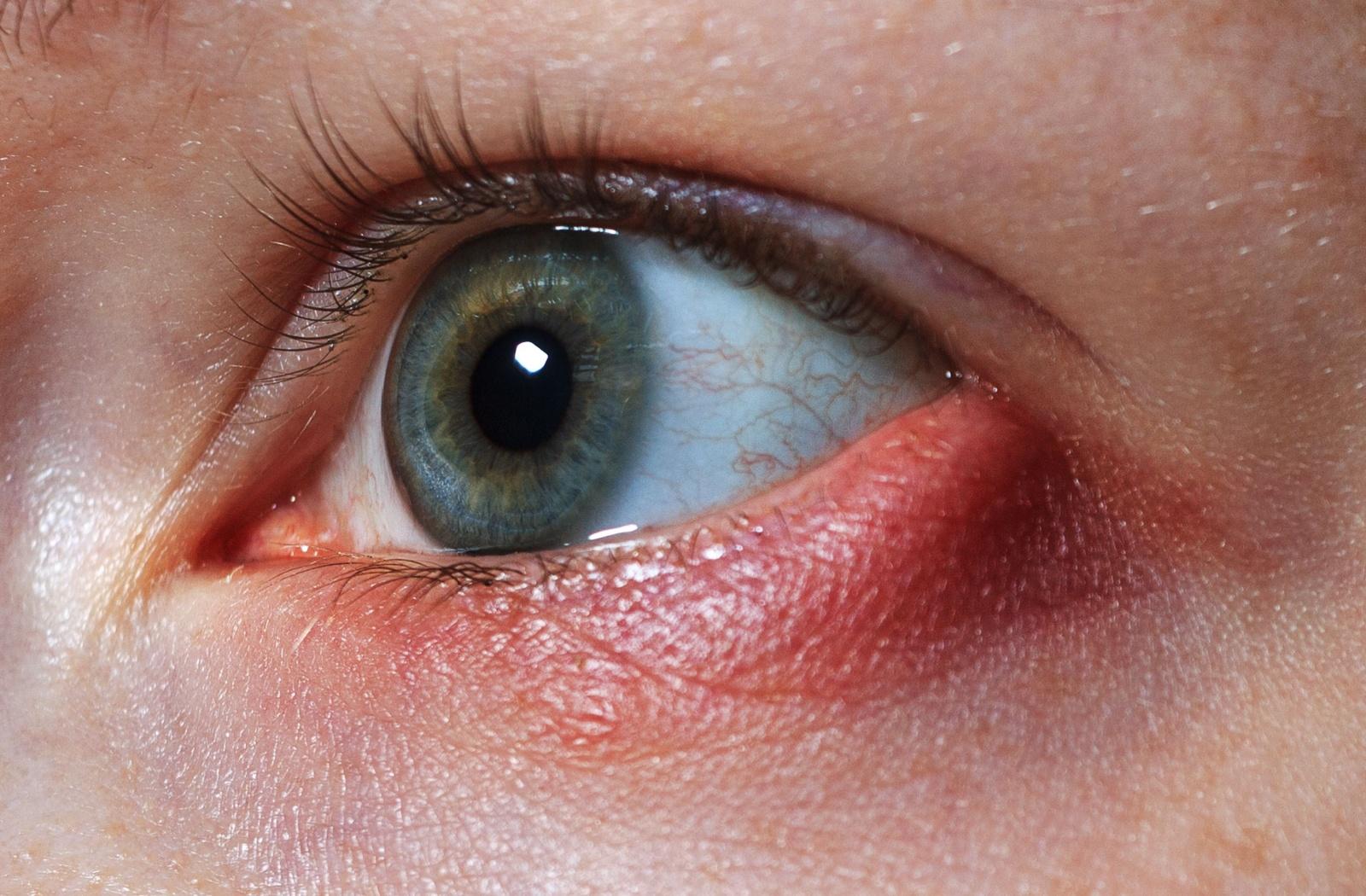 A close up of an eye stye chalazion.